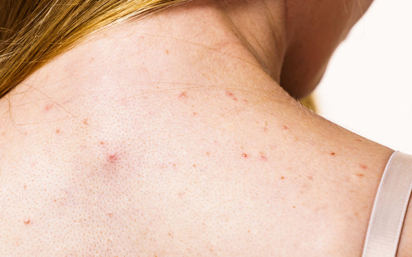 Banishing Body Acne Breakouts