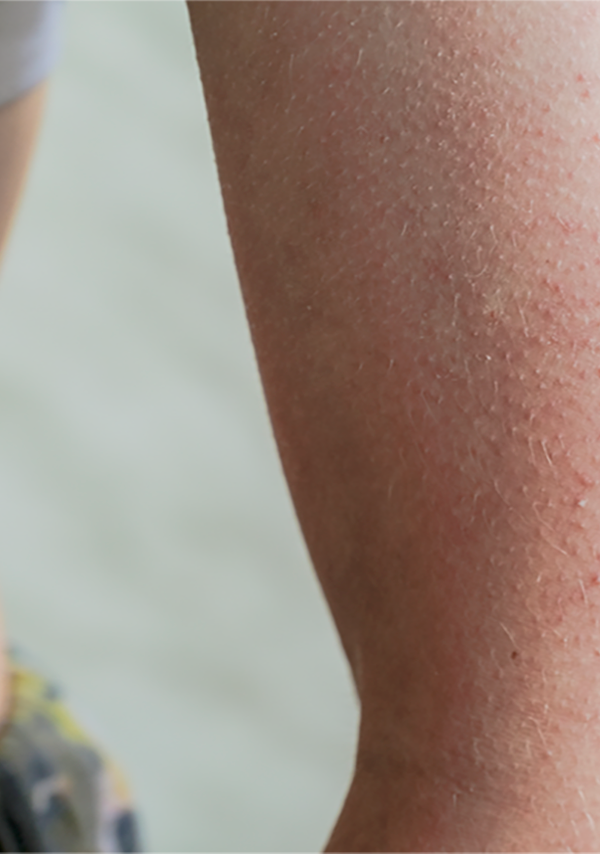 The Role of Lactic Acid in Caring for Keratosis Pilaris