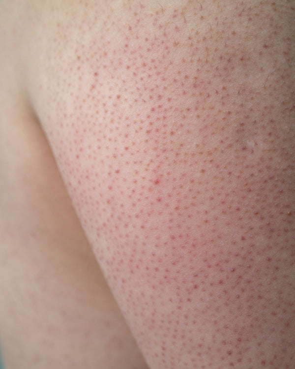 How to Manage Keratosis Pilaris (KP) 